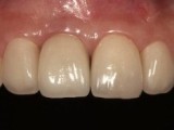 after implant