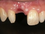 before implant